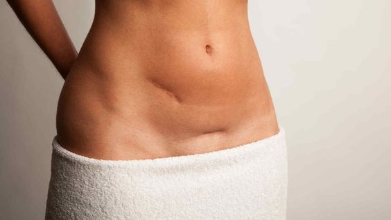 Wat houdt een keizersnede in