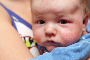 Huiduitslag bij baby's: hoe bestrijd je het?