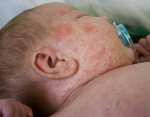 Miliaria bij baby’s, wat kun je ertegen doen?