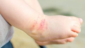 Tips voor als je kind dauwworm heeft