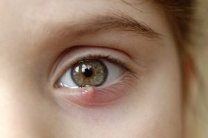 Help, mijn kind heeft een strontje in het oog! Hoe behandel ik dat?