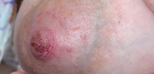 pijnlijke tepelkloven