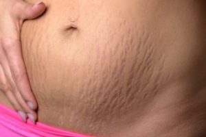Wat is striae en hoe kun je het behandelen?