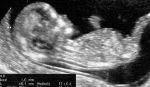 Echografie week 13 van je zwangerschap