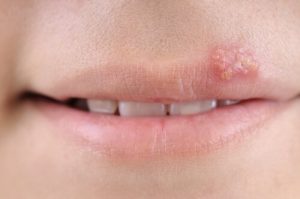 Herpes bij kinderen: symptomen, oorzaken en behandeling