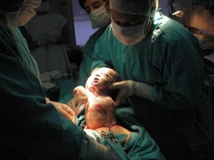 Evolutionaire effecten van een keizersnee op het lichaam van vrouwen