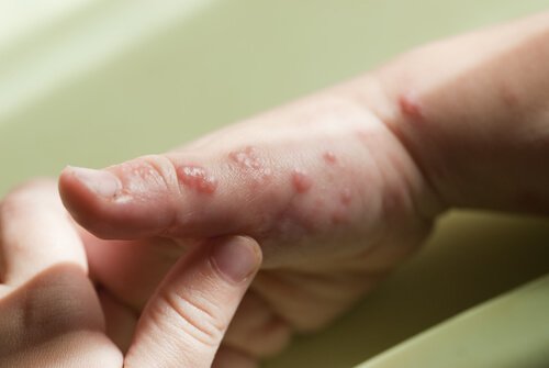 Herpes bij kinderen: blaasjes op de hand