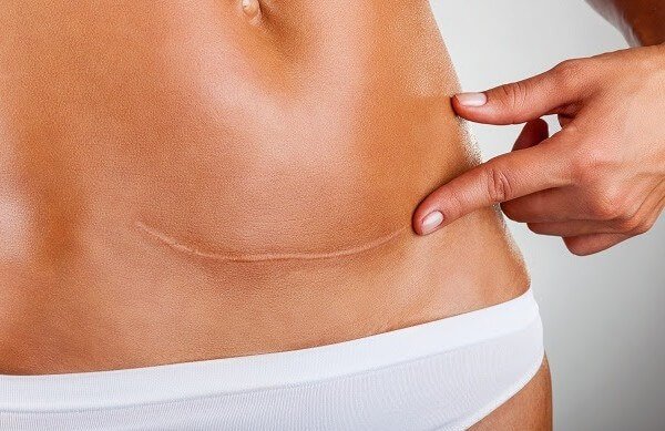 Effecten van een keizersnee