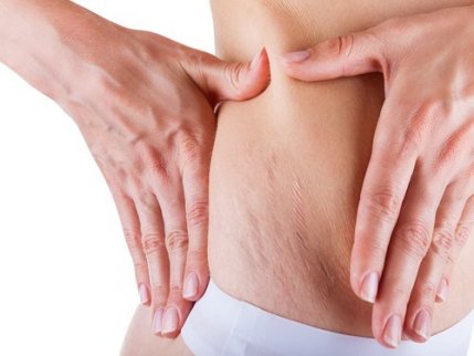 Wat is striae? Striae op heupen