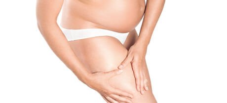 Wat is striae? Striae op benen