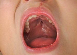 Kinderen met een gespleten gehemelte: alles wat je moet weten