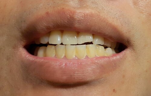 Het verschijnen van vlekken op blijvende tanden