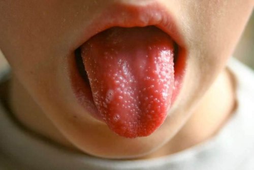 Roodvonk bij kinderen: tong