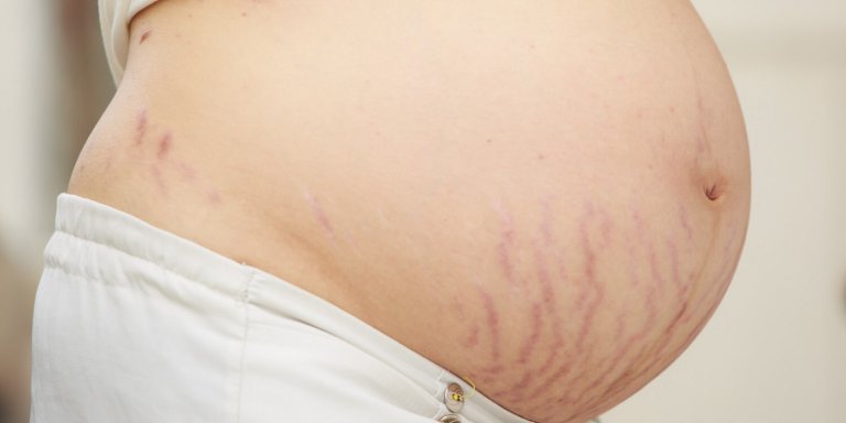 Breng een milde scrub aan om striae tijdens de zwangerschap te voorkomen