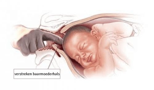 Hoe vindt het verstrijken van de baarmoederhals plaats
