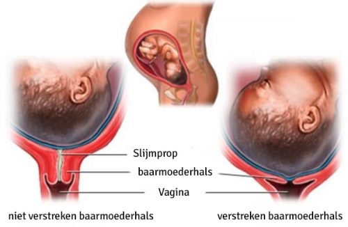 De fasen van het verstrijken van de baarmoederhals
