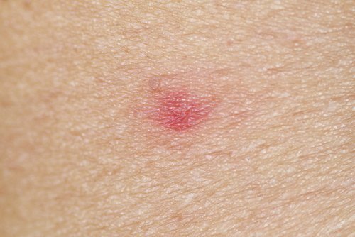 wespensteek in de huid