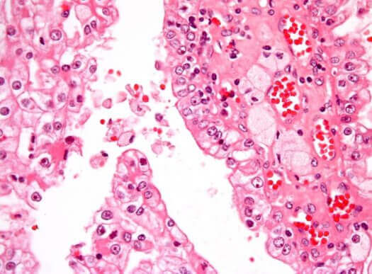 Kankercellen in de nier