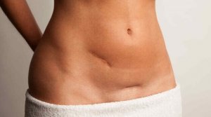 Tips voor het behandelen en verminderen van littekens