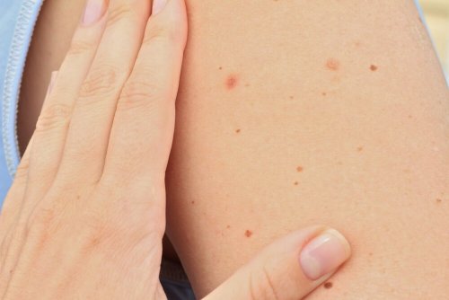 Arm met meerdere moedervlekken