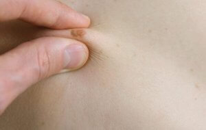 Hoe herken je het soort van een moedervlek