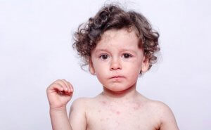 Allergieën voor zweet bij kinderen: symptomen en behandeling