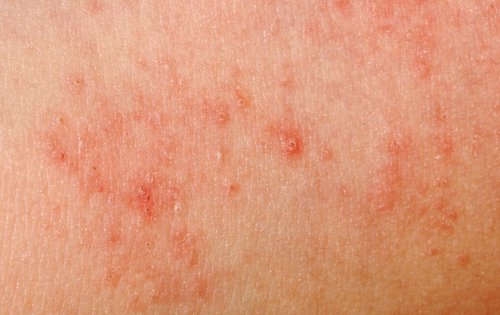 Huid allergie door zweten