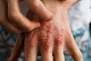 4 Remedies tegen psoriasis bij kinderen