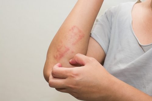 Psoriasis bij kinderen
