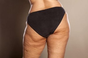 Weet jij hoe je cellulitis kan bestrijden?