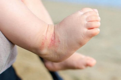 Babyvoetje met eczeem