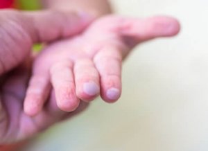 Blaren bij kinderen en hoe ze te behandelen