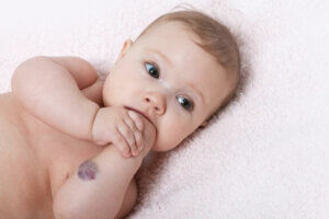 Veelvoorkomende craniofaciale afwijkingen bij baby's