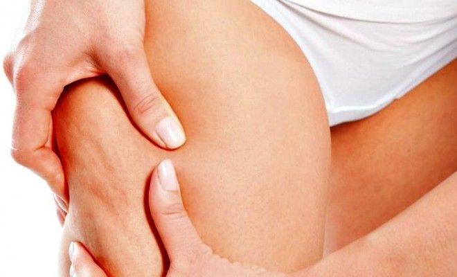 Sinaasappelhuid na de bevalling