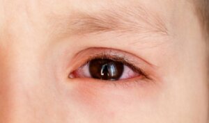 Oorzaken van een bloeduitstorting op het oog bij kinderen