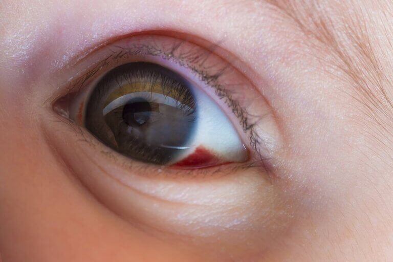 Bloeduitstorting op het oog
