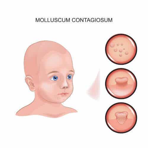 Molluscum contagiosum bij je kind
