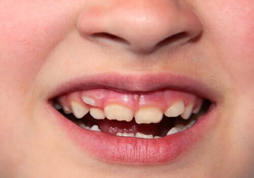 Verkeerd doorgekomen tanden bij kinderen: wat te doen?