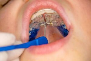 Wat is een te hoog gehemelte bij kinderen?