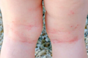 10 vragen over atopische dermatitis