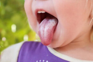 Orale candidiasis bij kinderen: symptomen, oorzaken en behandeling