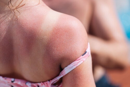 Zonnebrand bij kinderen: waarom is het zo gevaarlijk?