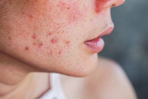 10 Huismiddeltjes tegen acne tijdens de zwangerschap