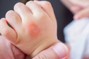 Hoe herken je insectenbeten bij kinderen?