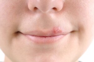 De natuurlijke behandeling van herpes bij kinderen
