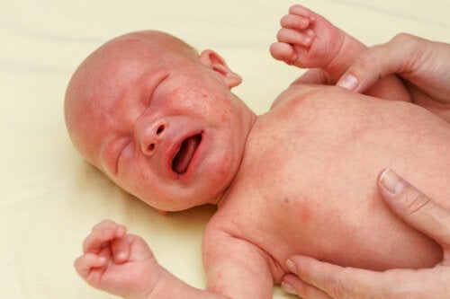 Petechiën bij baby's: oorzaken, symptomen en behandeling