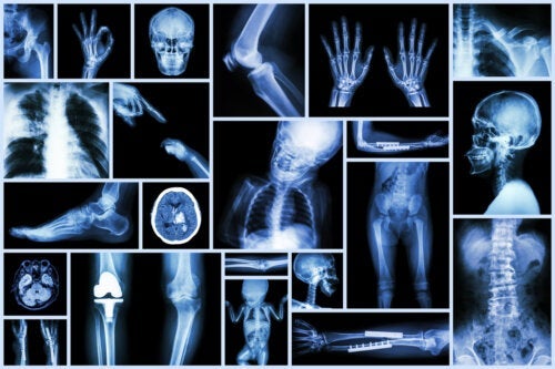Röntgenstralen bij kinderen: wat je moet weten