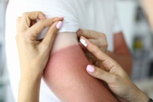 Natuurlijke remedies tegen zonnebrand