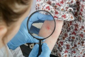 Natuurlijke remedies tegen atopische dermatitis bij baby's en kinderen