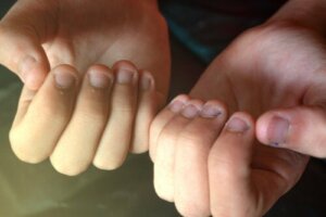 Onychofagie bij kinderen: wat je moet weten